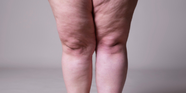 a-turkish-doctor-shed-light-on-lipedema-a-disease-common-among-women-3lWlWfgb.jpg