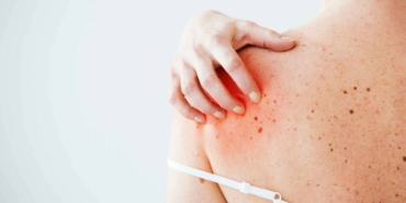 beware-of-the-suns-harm-turkish-doctor-highlights-skin-tumor-risks-NzRwfhjU.jpg