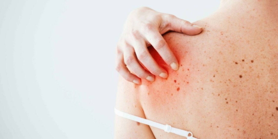 Beware of the sun’s harm Turkish doctor highlights skin tumor risks