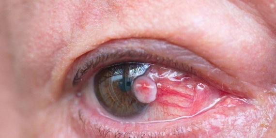 Experts warn about a subtle early symptom of eye cancer