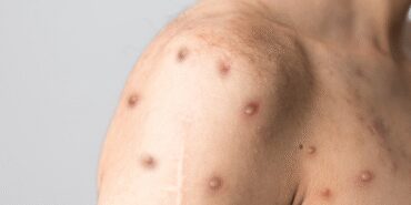 growing-concern-as-m-virus-outbreak-expands-MIFiAnsO.jpg