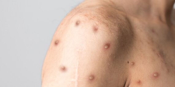 Growing Concern as M Virus Outbreak Expands